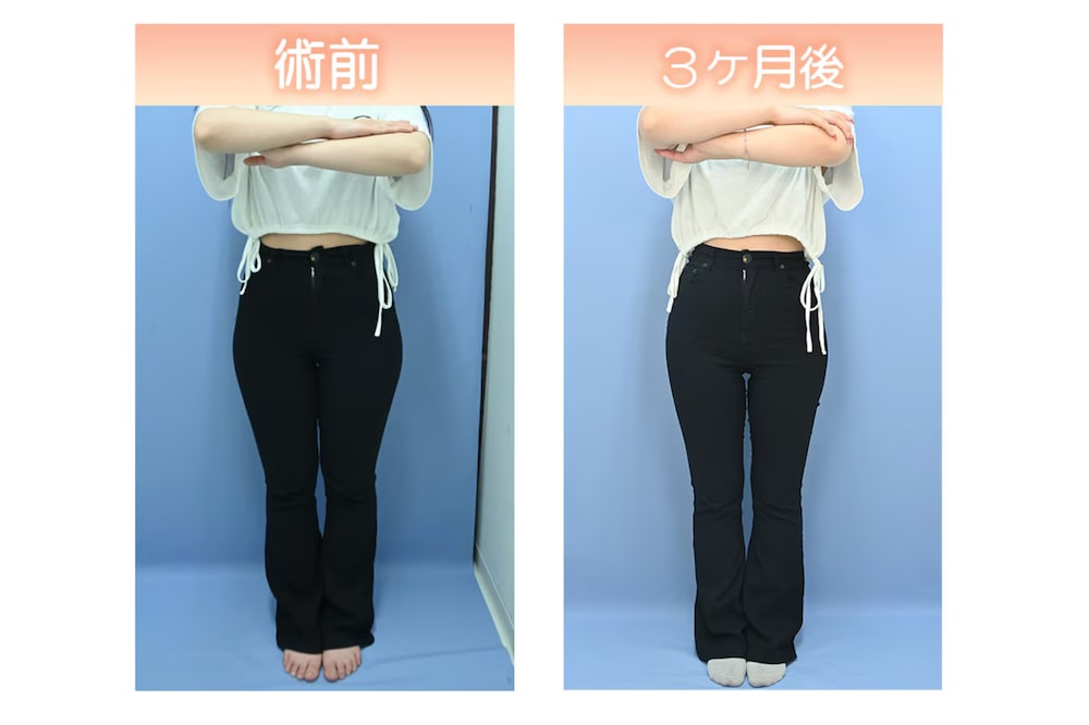 アキーセル脂肪吸引ベイザープラス（太もも・お尻・膝・腰・ウエスト）
