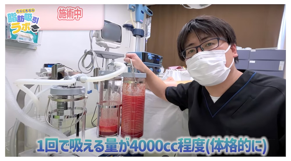 脂肪吸引の途中経過（後面吸引後）