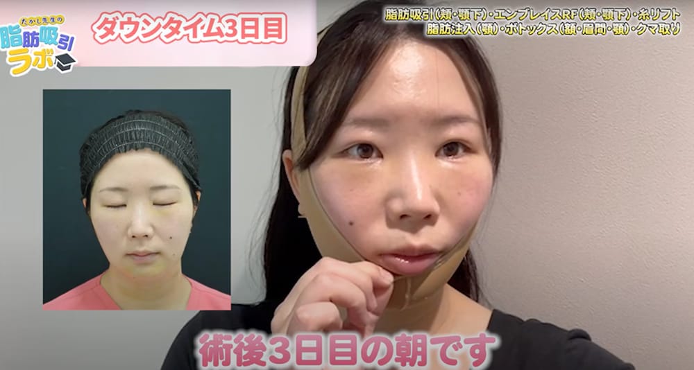 ダウンタイム3日目の朝