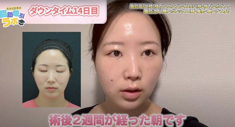 術後２週間目の朝