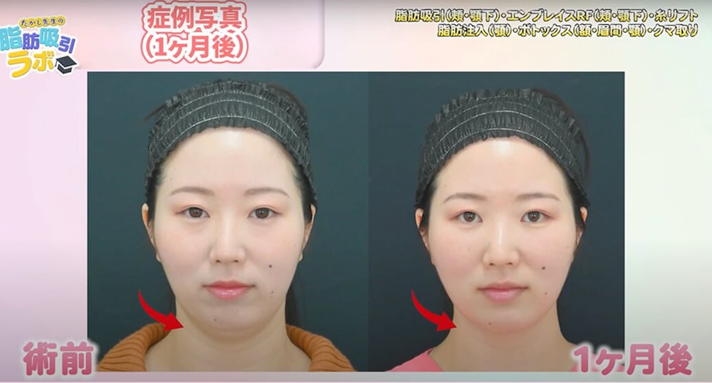 1ヶ月の症例写真