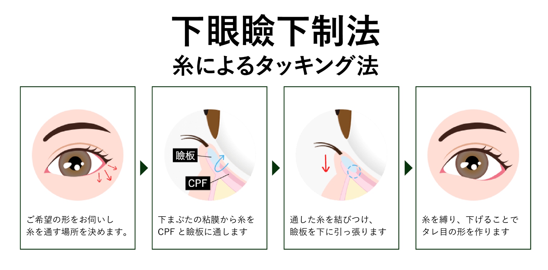 ① 糸によるタッキング法