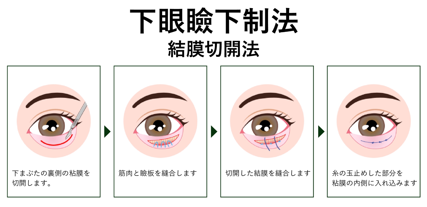 ②-1 結膜切開法