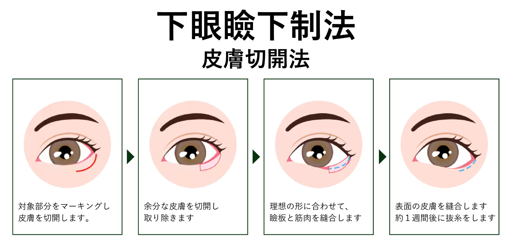 ②-2 皮膚切開法
