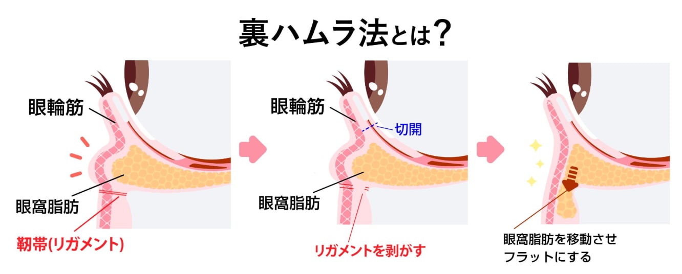 自身の脂肪を再配置する究極の根本治療