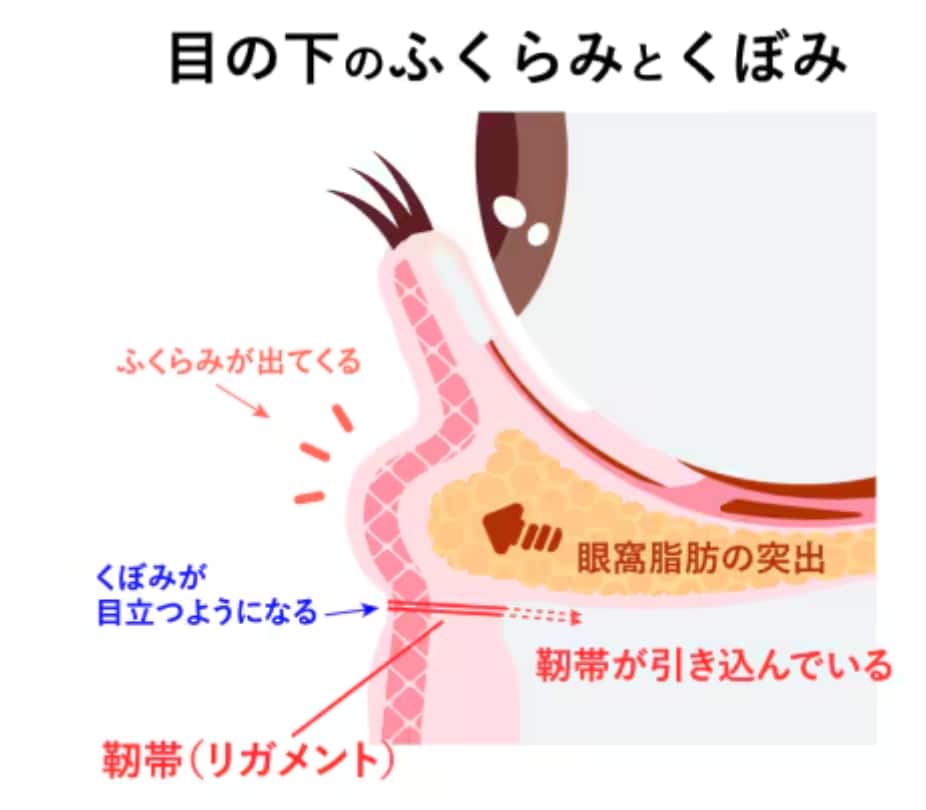 なぜ目の下に「ふくらみ」と「くぼみ」ができるのか？