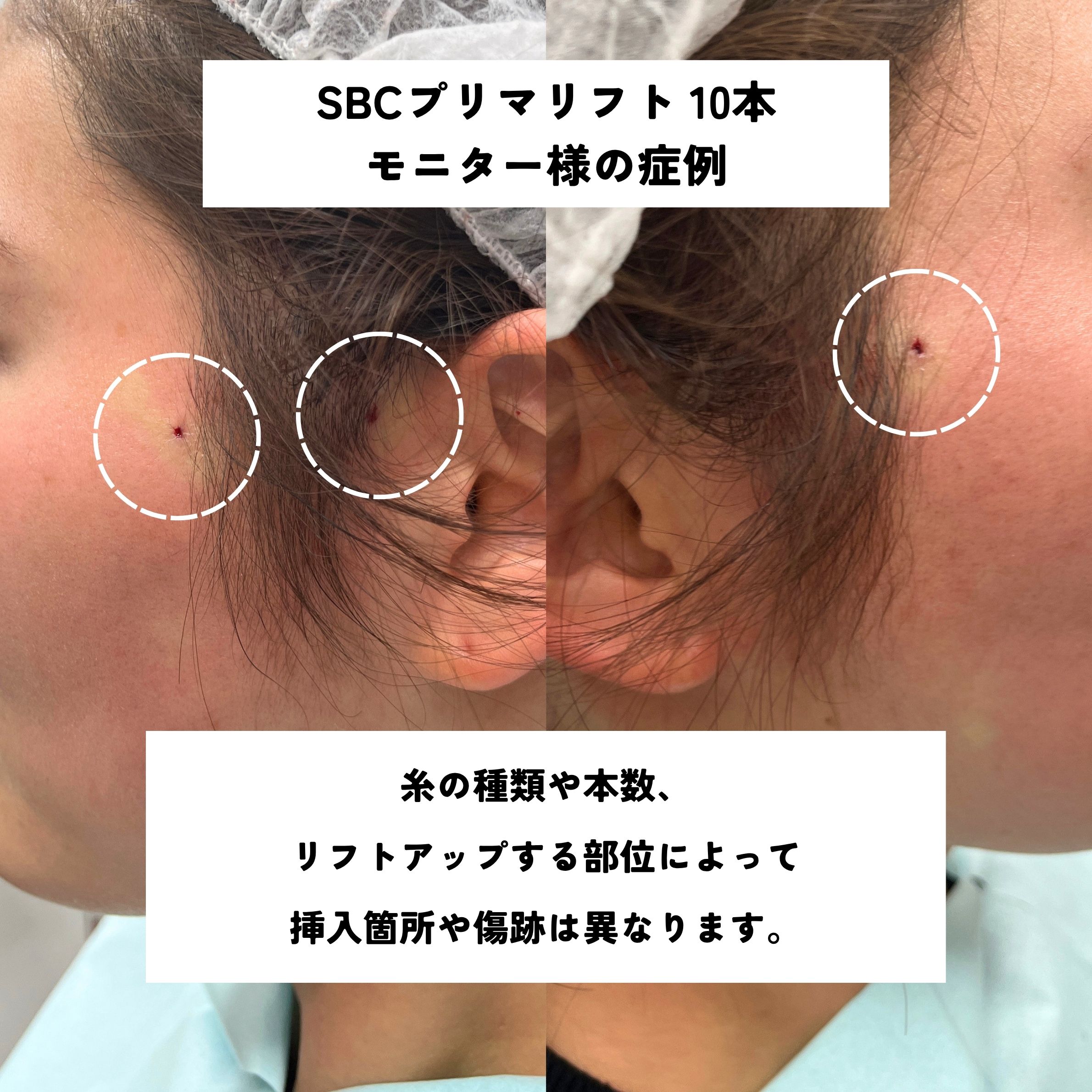 傷跡の大きさどのくらい！？