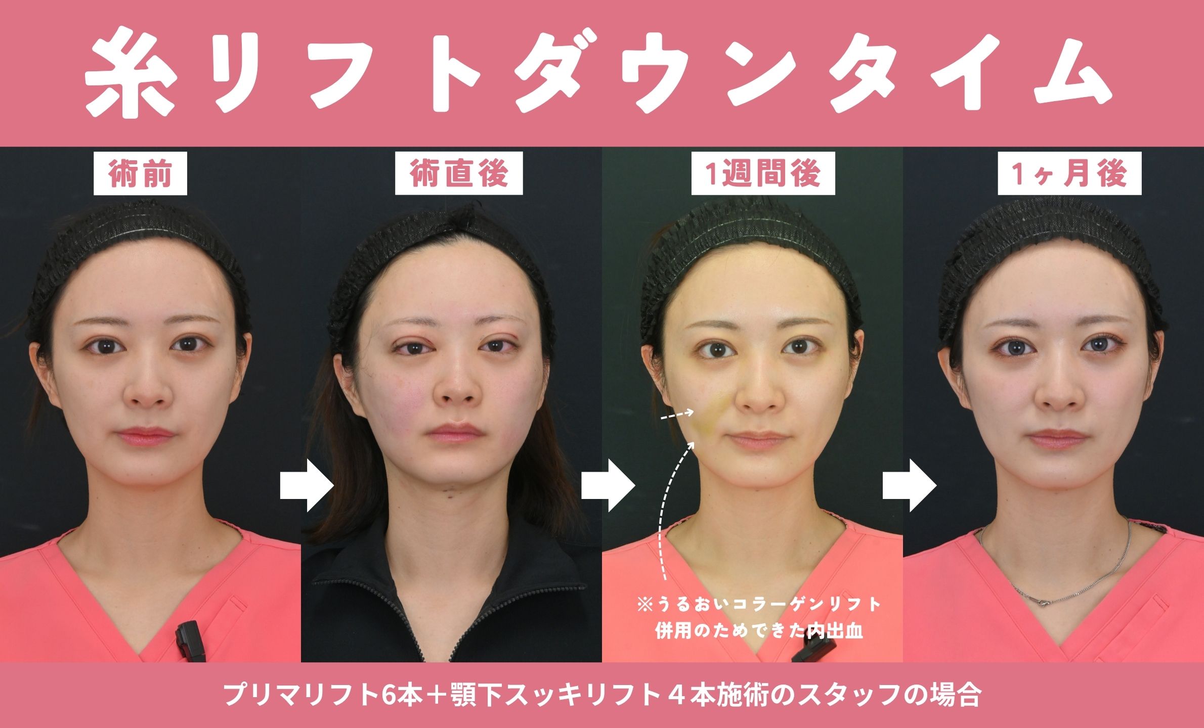 ダウンタイム