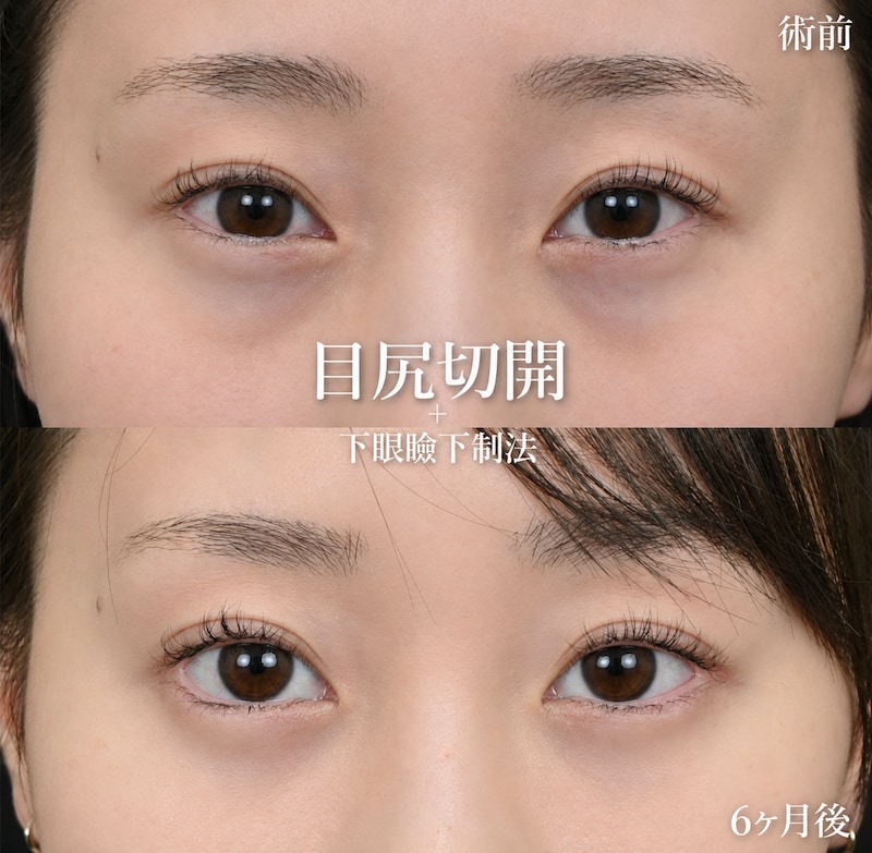 ツリ目やキツい印象を「優しい雰囲気」へ
