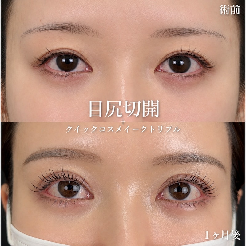 目の横幅を広げて「デカ目」と「小顔」を同時に叶える