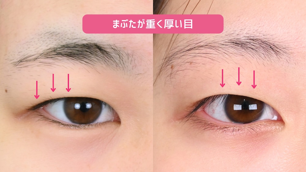 まぶたの厚み・脂肪のつき方