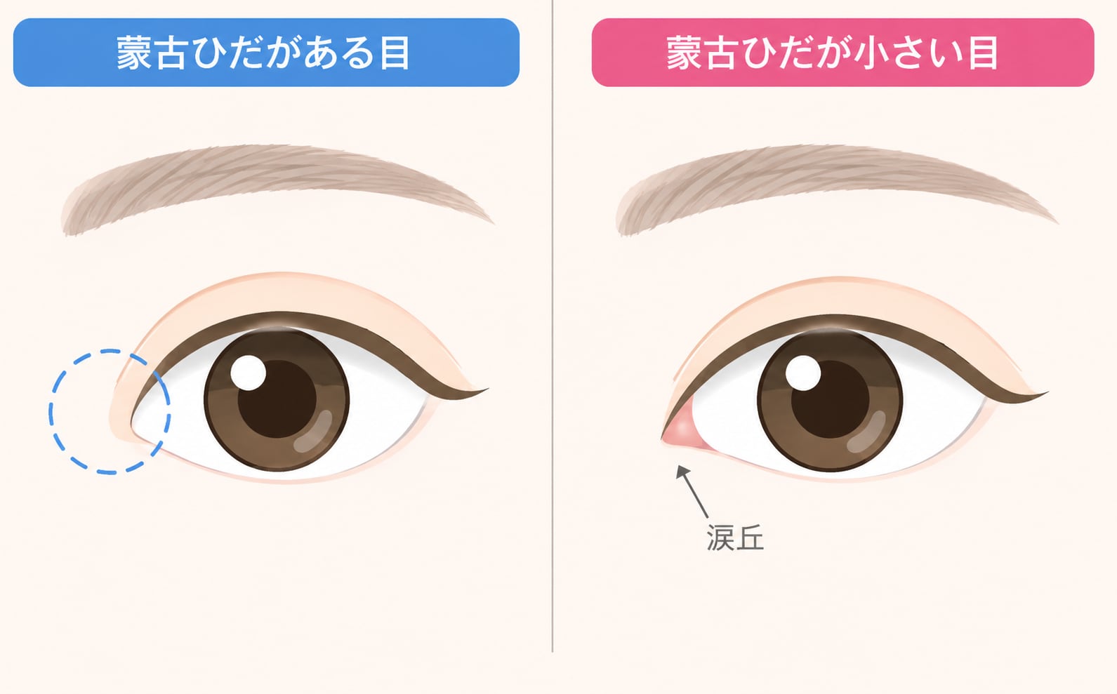 蒙古襞（もうこひだ）の張り