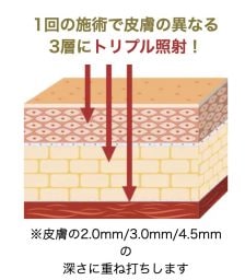 トリプル照射とは？