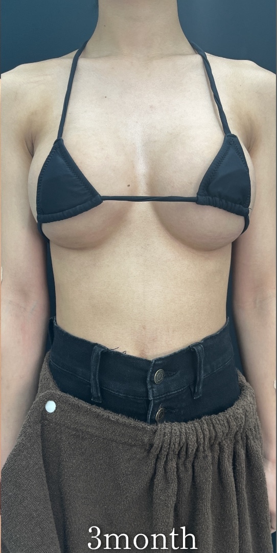 {シリコンバック豊胸} {20代}  {女性} の術後の症例写真