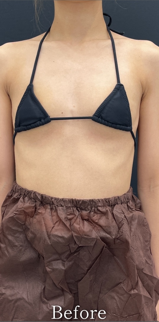 {シリコンバック豊胸} {20代}  {女性} の術前の症例写真