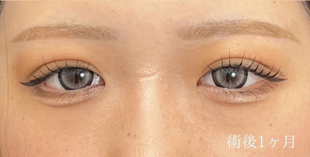 {クイックコスメティークダブル} {10代}  {女性} の術後の症例写真