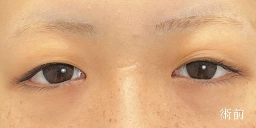 {クイックコスメティークダブル} {10代}  {女性} の術前の症例写真