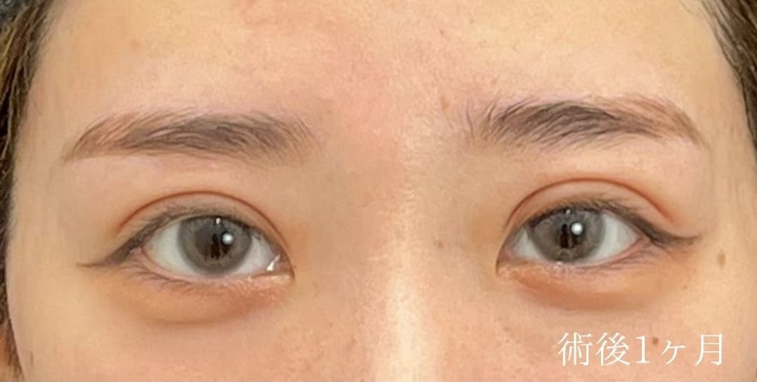 {クイックコスメティークトリプル} {20代}  {女性} の術後の症例写真