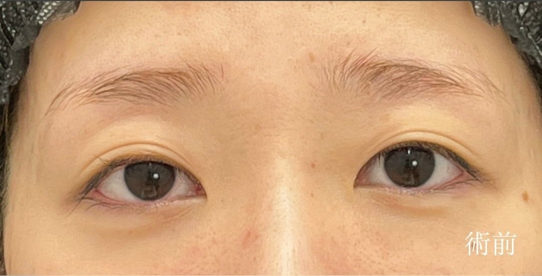 {クイックコスメティークトリプル} {20代}  {女性} の術前の症例写真