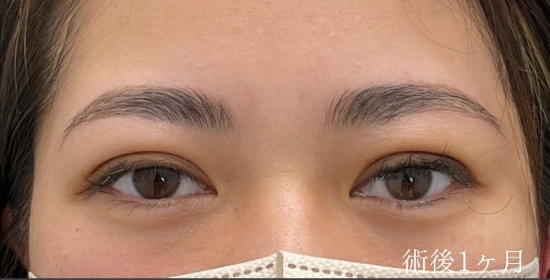 {クイックコスメティークトリプル} {20代}  {女性} の術後の症例写真