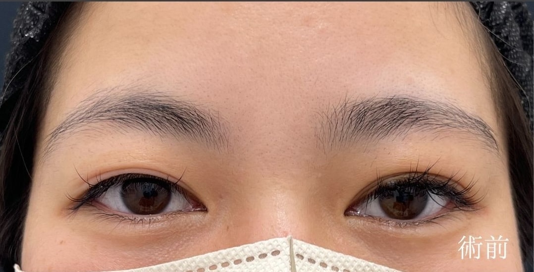 {クイックコスメティークトリプル} {20代}  {女性} の術前の症例写真