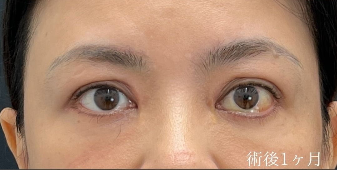 {アイバックリムーブ} {40代}  {女性} の術後の症例写真