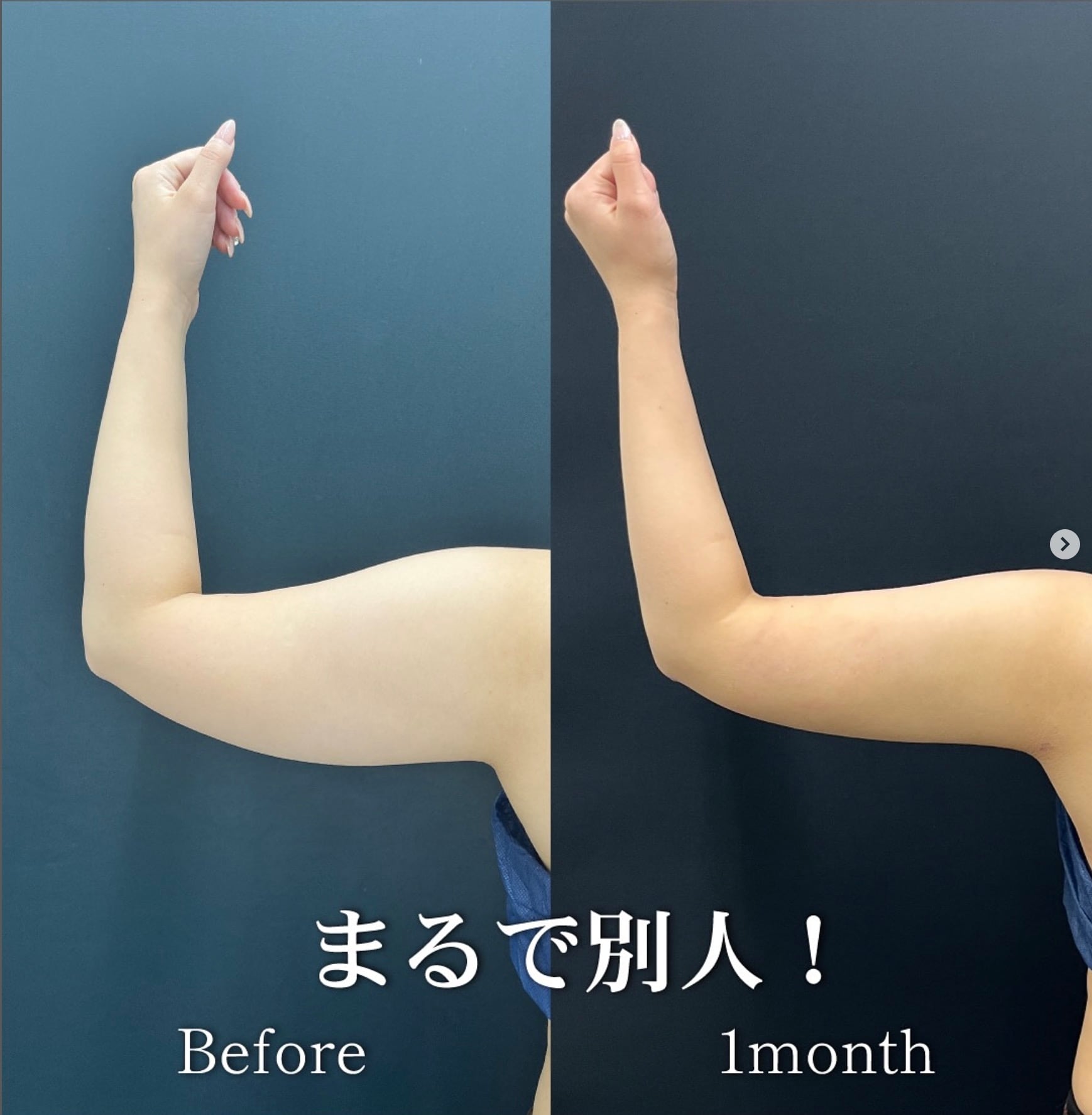 脂肪吸引は術後に圧迫をしなければなりません。<br />
暑い時期だと圧迫が少し辛い…<br />
という事で寒い時期に人気です！<br />
