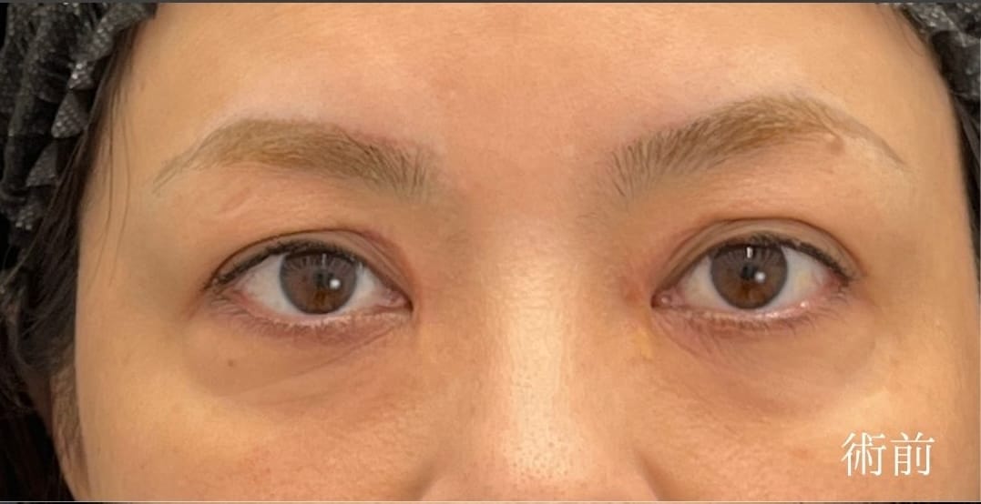 {アイバックリムーブ} {40代}  {女性} の術前の症例写真