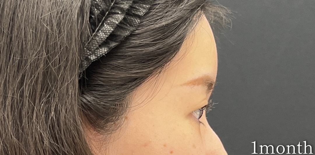 {コンデンスリッチ} {20代}  {女性} の術後の症例写真