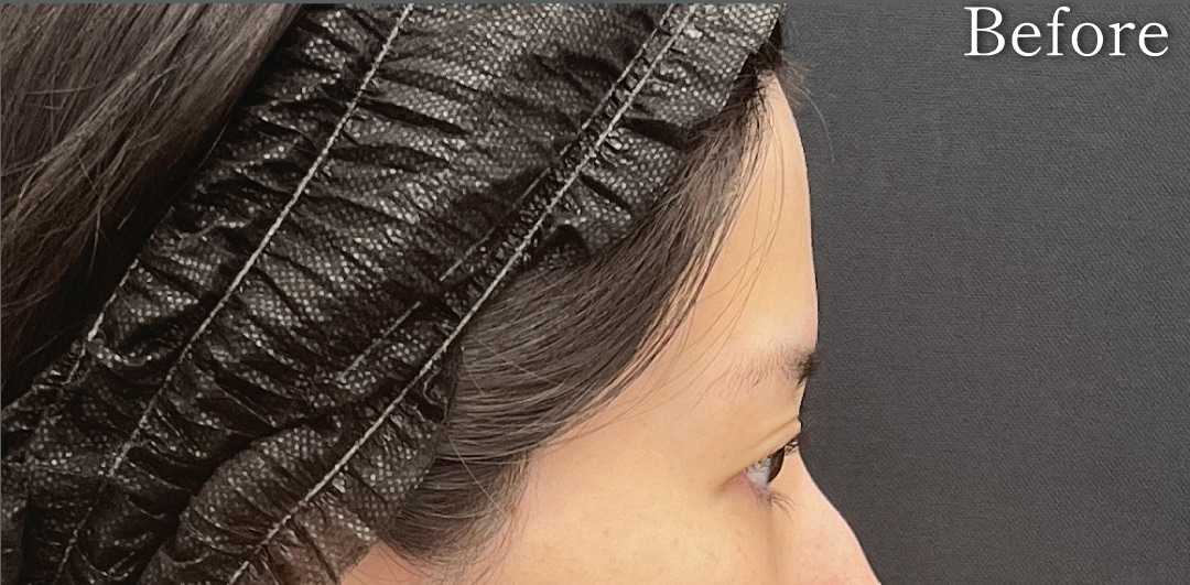 {コンデンスリッチ} {20代}  {女性} の術前の症例写真