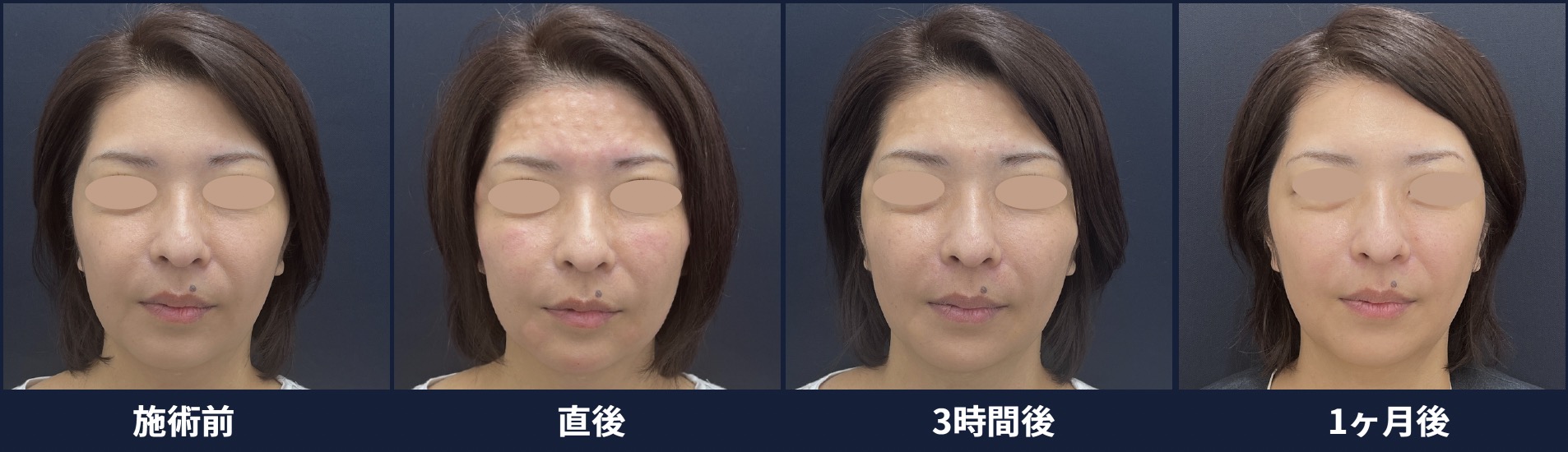 今年導入新治療💖ジャルプロスーパーハイドロ