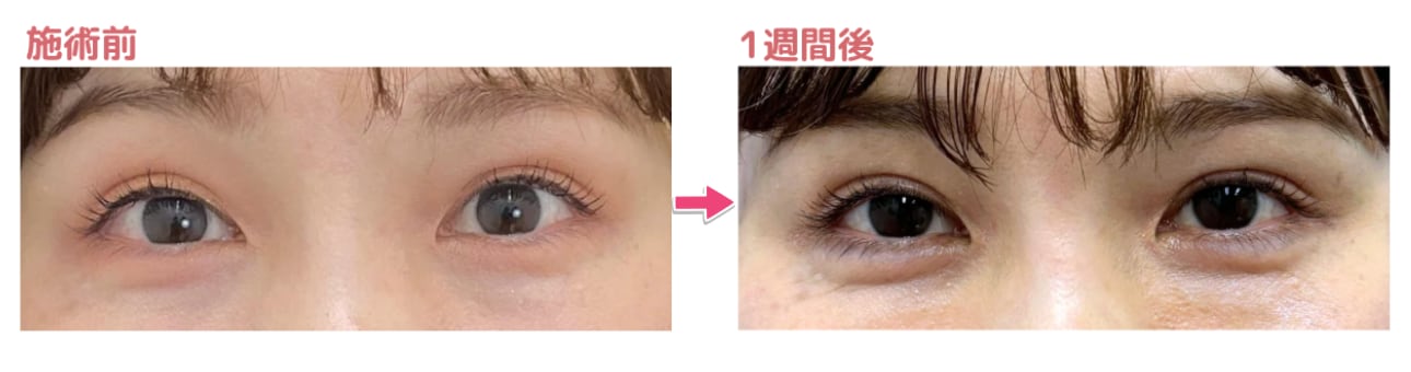 保水効果も高く単に膨らむだけでなく、ハリと潤いのある可愛らしい目元再現！