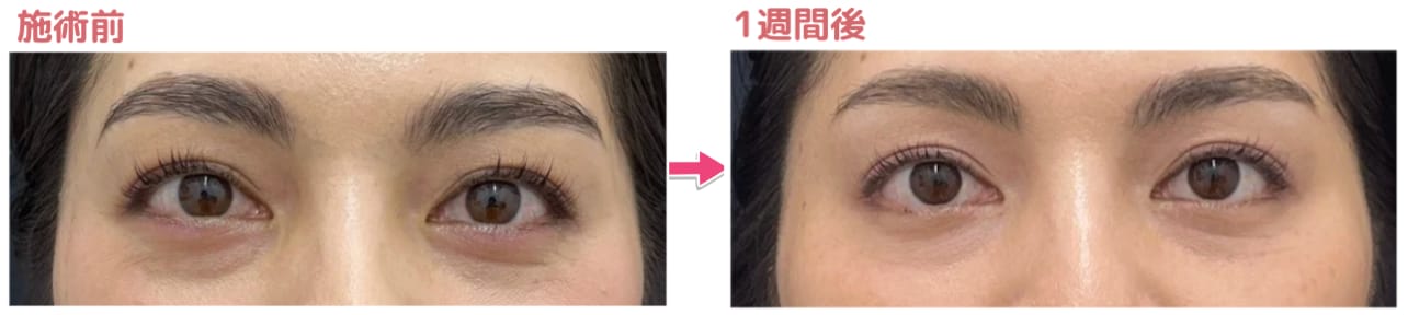 話題の肌育注射✨