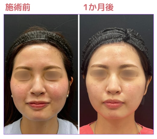 脂肪細胞の数自体を減らすことでリバウンドを防ぐ！部分的に脂肪を減らしたい方必見！