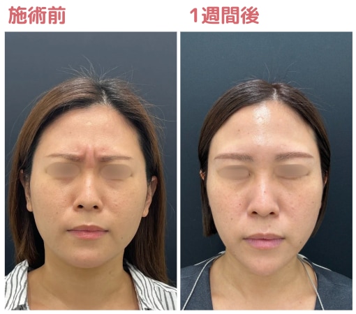 表情筋の働きが穏やかになり、シワが寄りにくくなります！