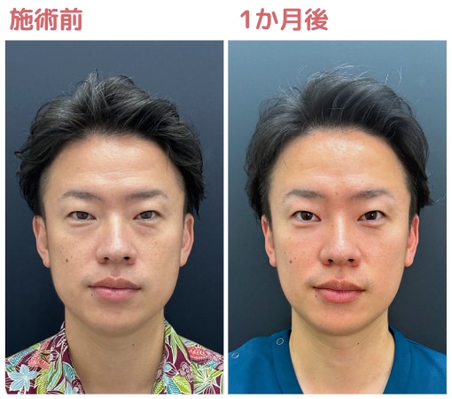 目の下の切らないクマ取り・たるみ（ふくらみ）取り+脂肪注入で疲れ顔から脱出！！！