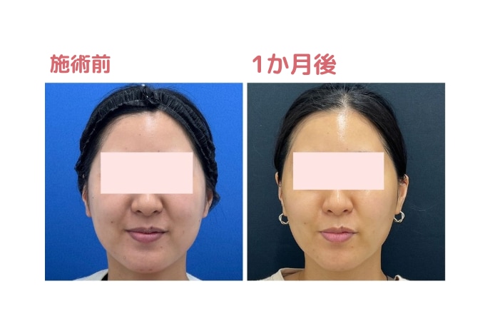 顔の脂肪や部分痩せを目的におすすめ！