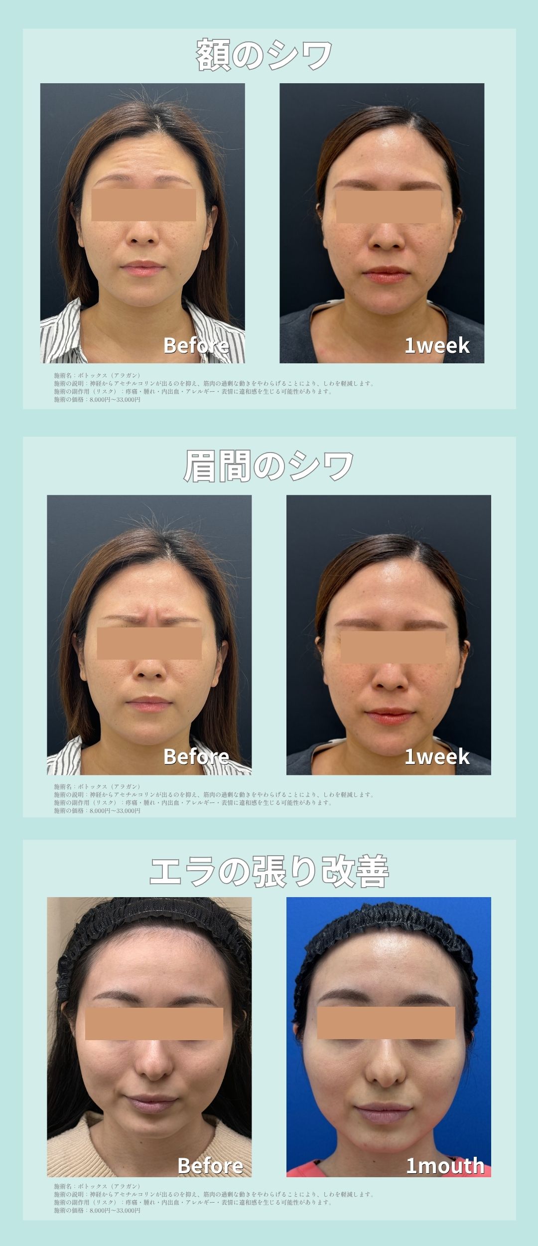 症例写真で見るボトックスの効果