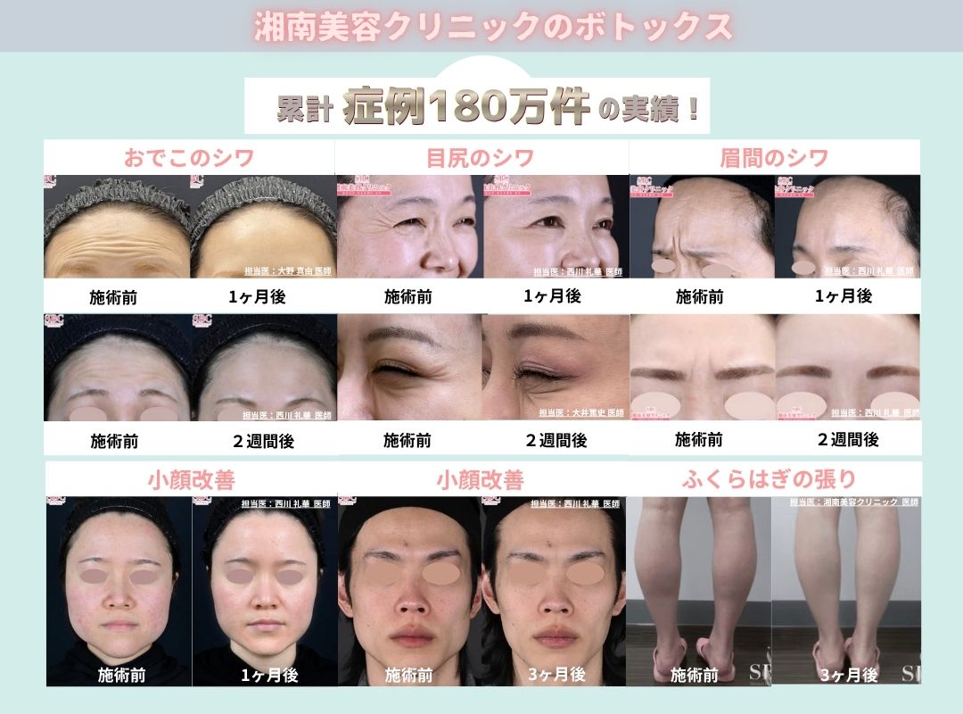湘南美容クリニックのボトックス治療