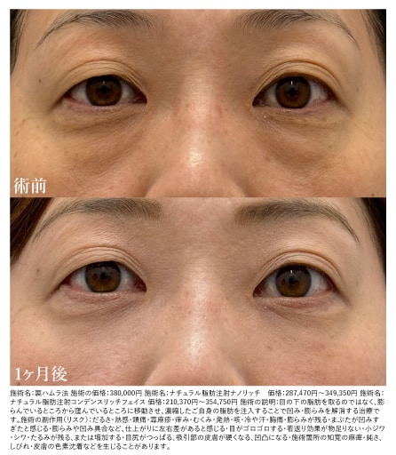 裏ハムラ＋脂肪注入症例：40代後半・女性