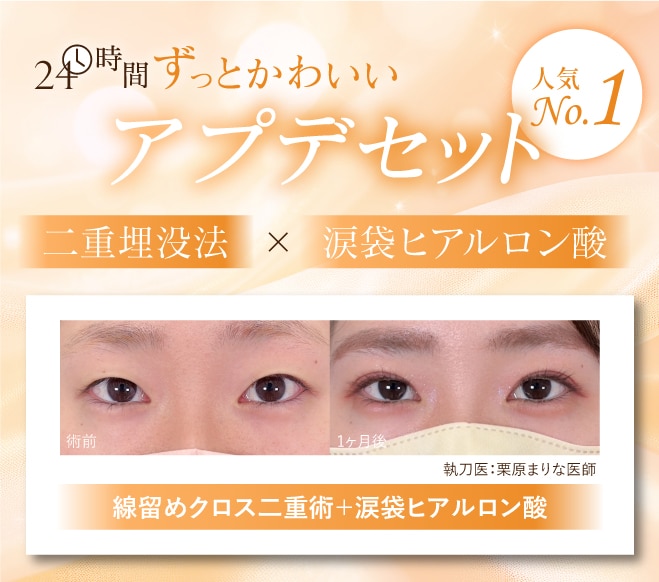 アプデセット