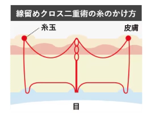 線留めクロス二重術とは