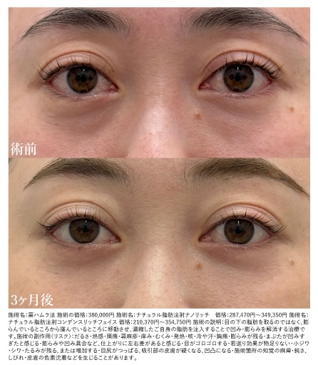 裏ハムラ＋脂肪注入症例：30代前半・女性