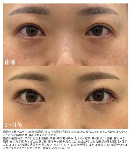 裏ハムラ症例：40代前半・女性
