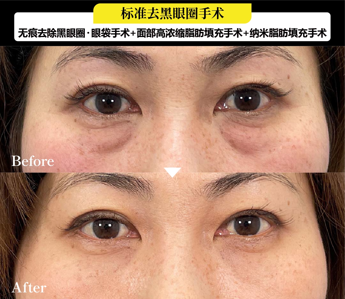 去黑眼圈案例:40岁后半、女性