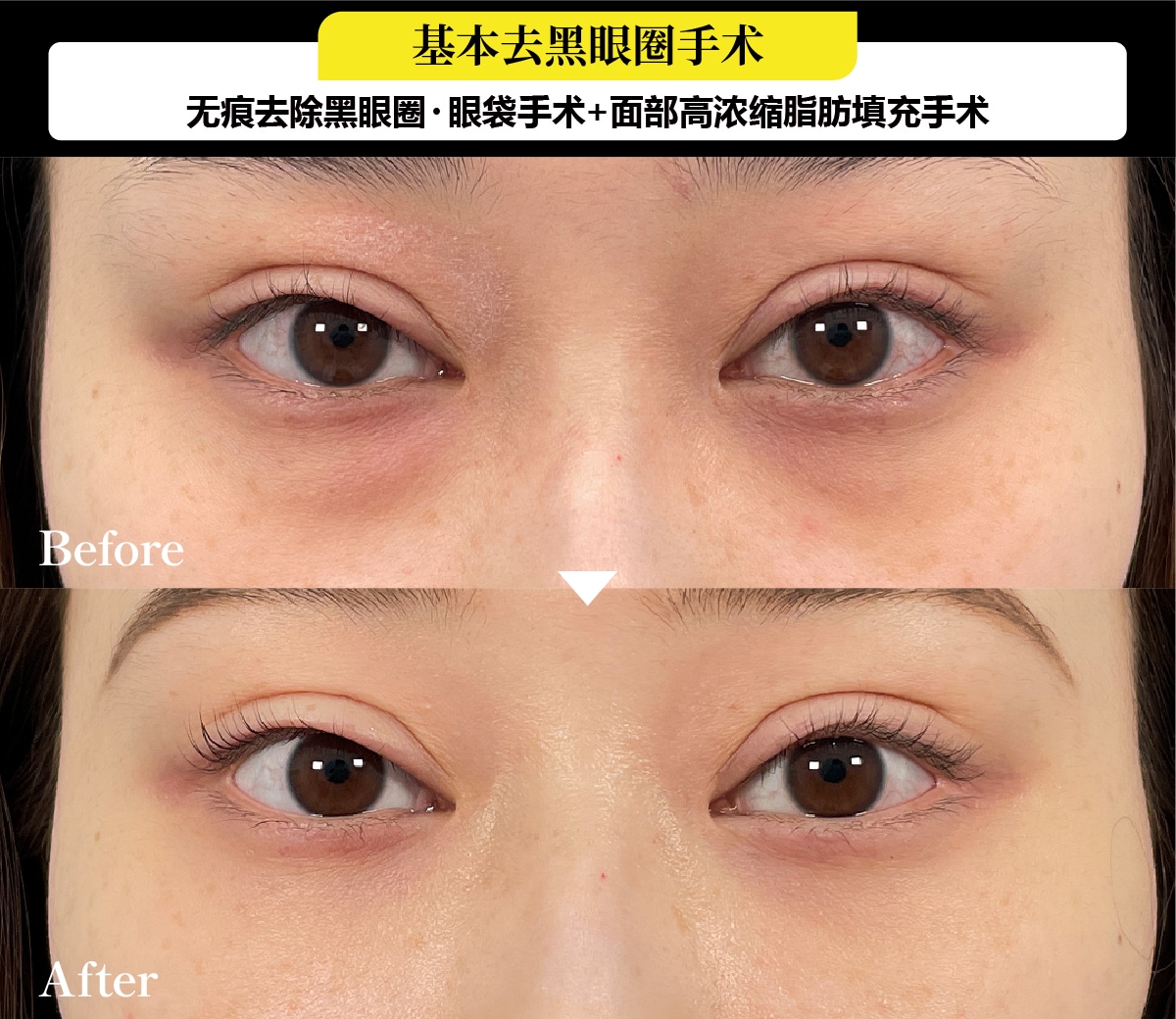 去黑眼圈案例:20岁后半、女性