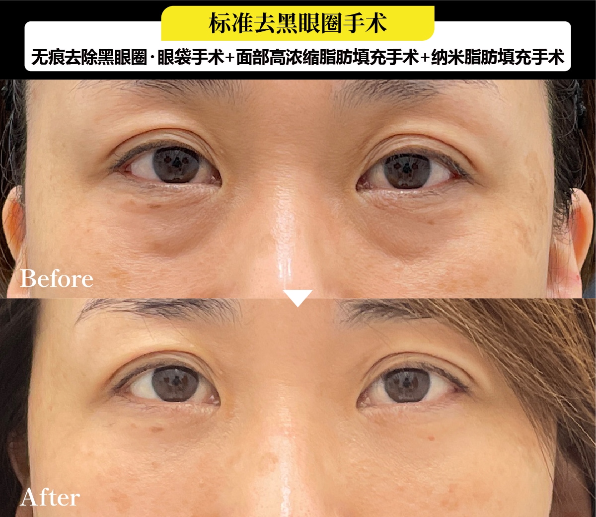 去黑眼圈案例:50岁前半、女性