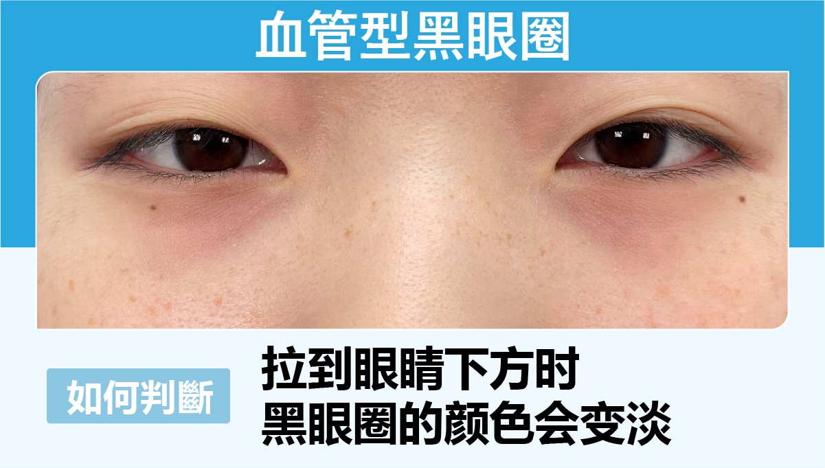 血管型黑眼圈