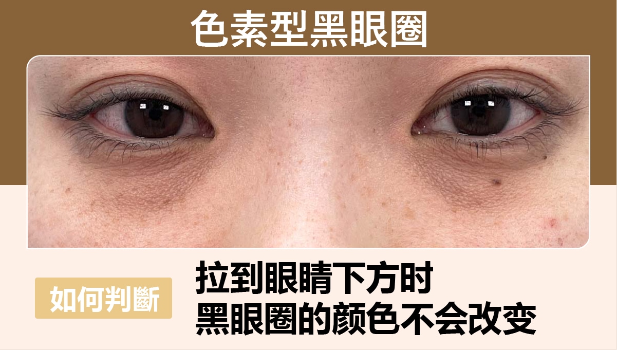 色素型黑眼圈