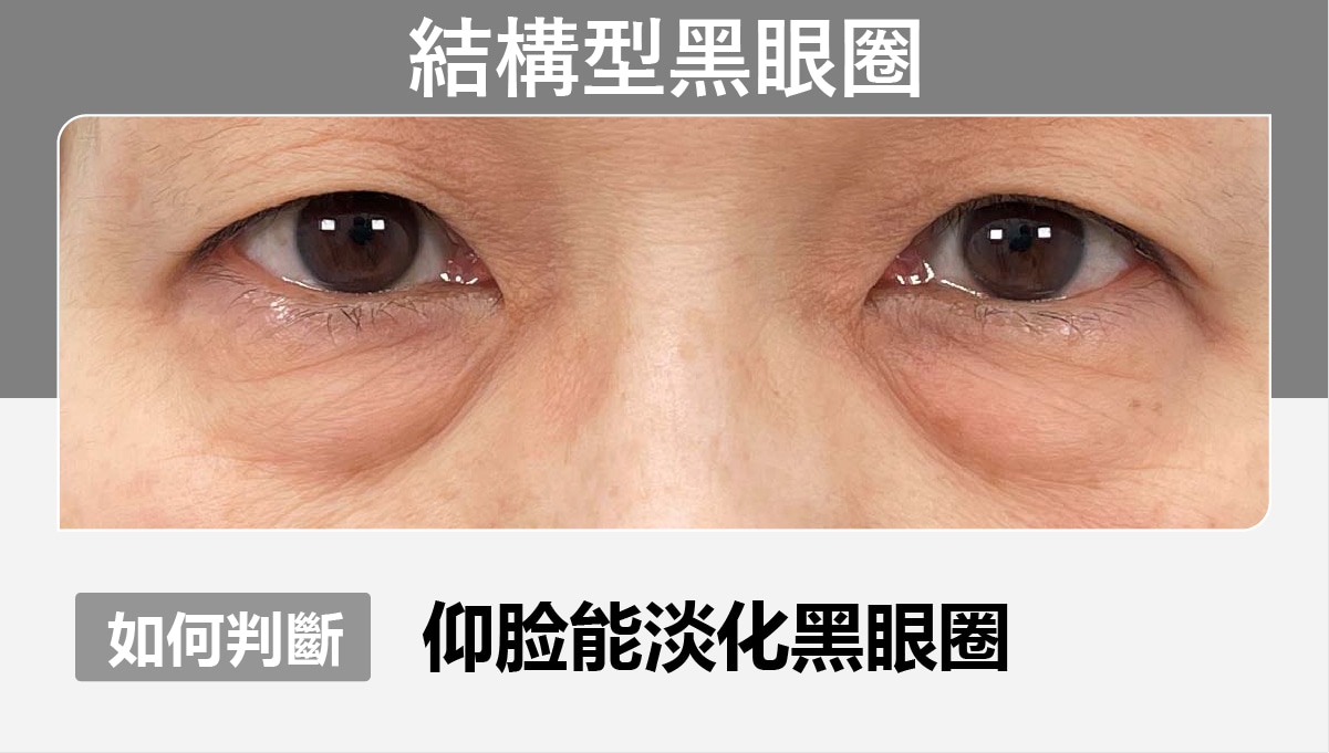 結構型黑眼圈